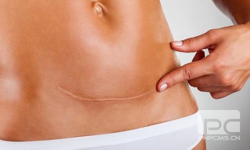 在哪些情况下会选择进行剖腹产手术呢？